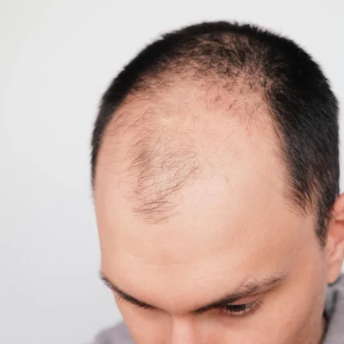 Receding Hairline